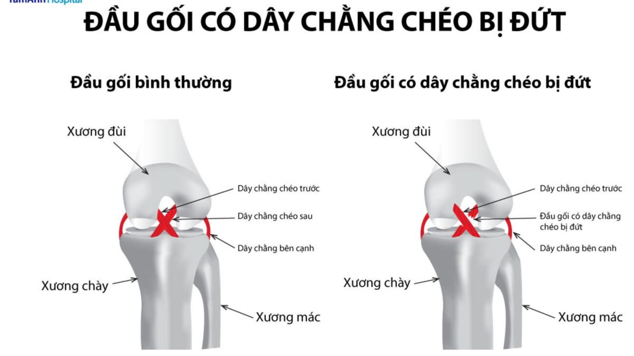 Chấn thương dây chằng đầu gối là gì? Và cách điều trị phục hồi